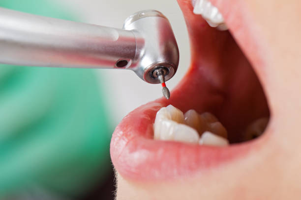 Best Lost Filling or Crown Replacement in Middletown, KY